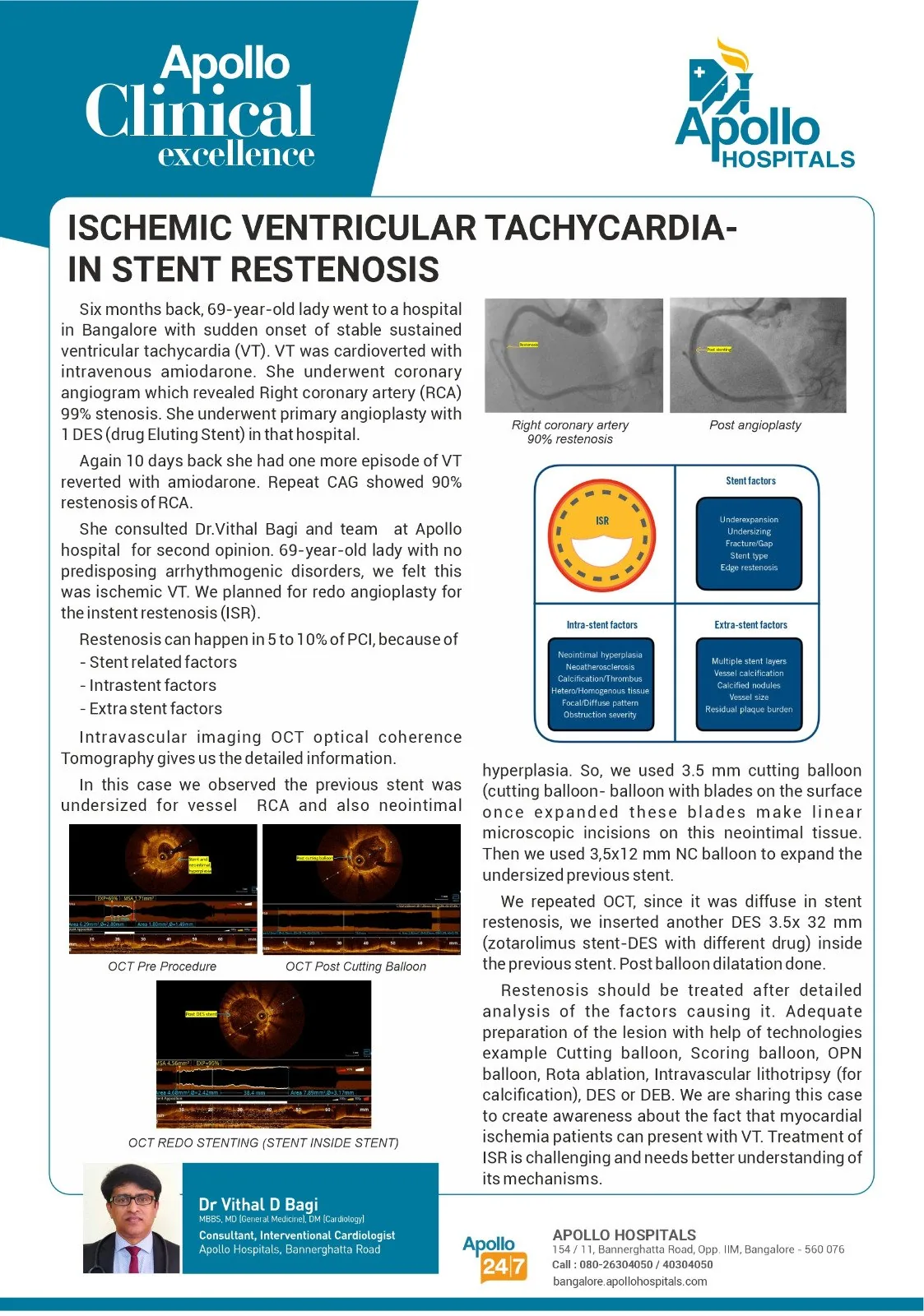 ISCHEMIC VENTRICULAR TACHYCARDIA-IN STENT RESTENOSIS