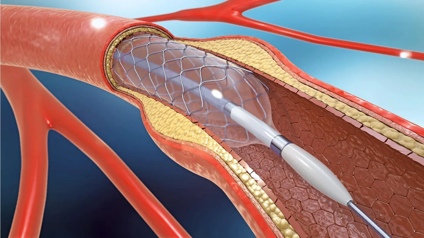 Angioplasty