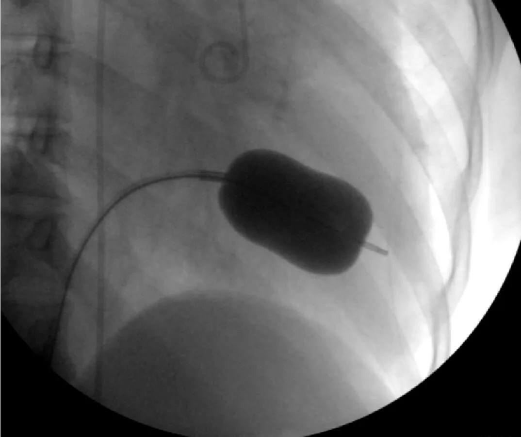 Balloon Valvuloplasty