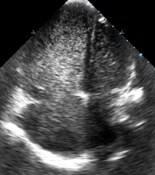 Contrast Echocardiography