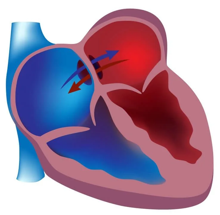 Device Closure — cardiac care at Dr. Bagi Heart Centre