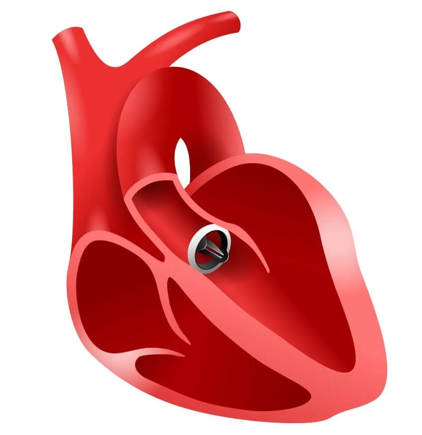 Heart Valve Surgery