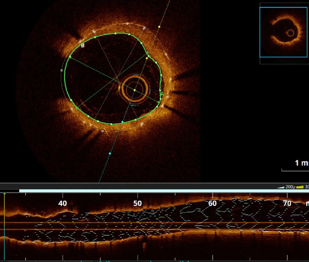 Intravascular Imaging