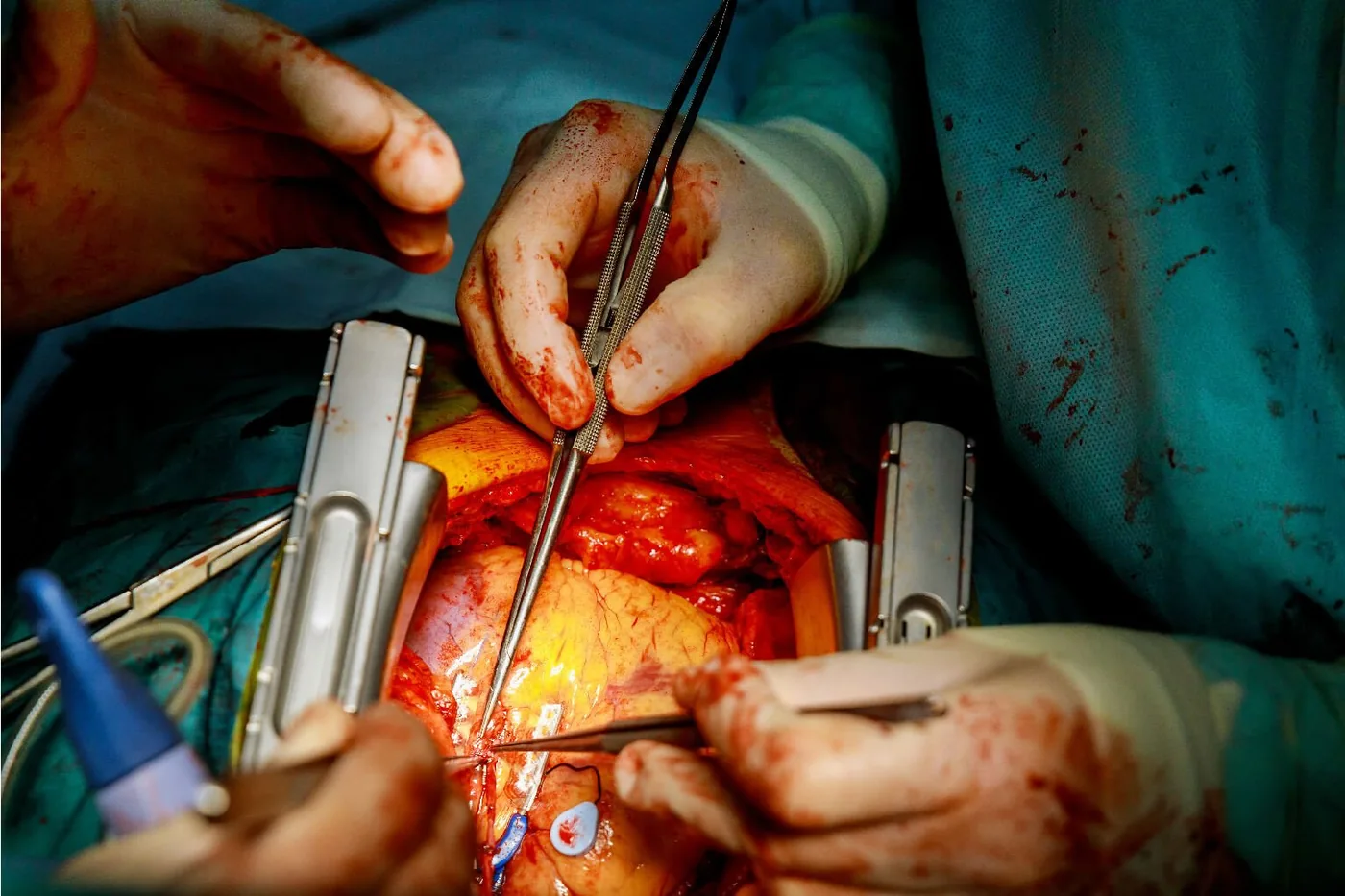 Minimally Invasive Cardiac Surgery
