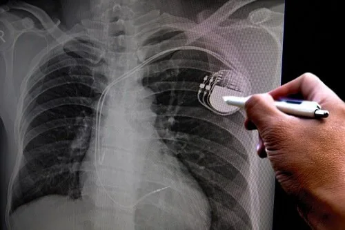 Pacemaker Implantation