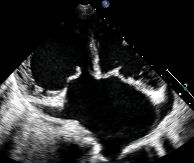 Pediatric Echocardiography