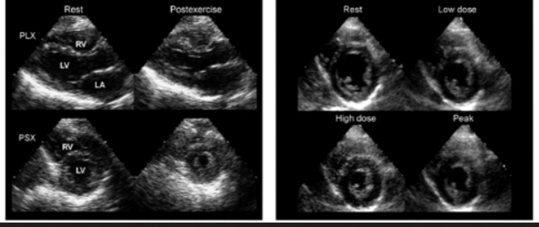 Stress Echocardiography