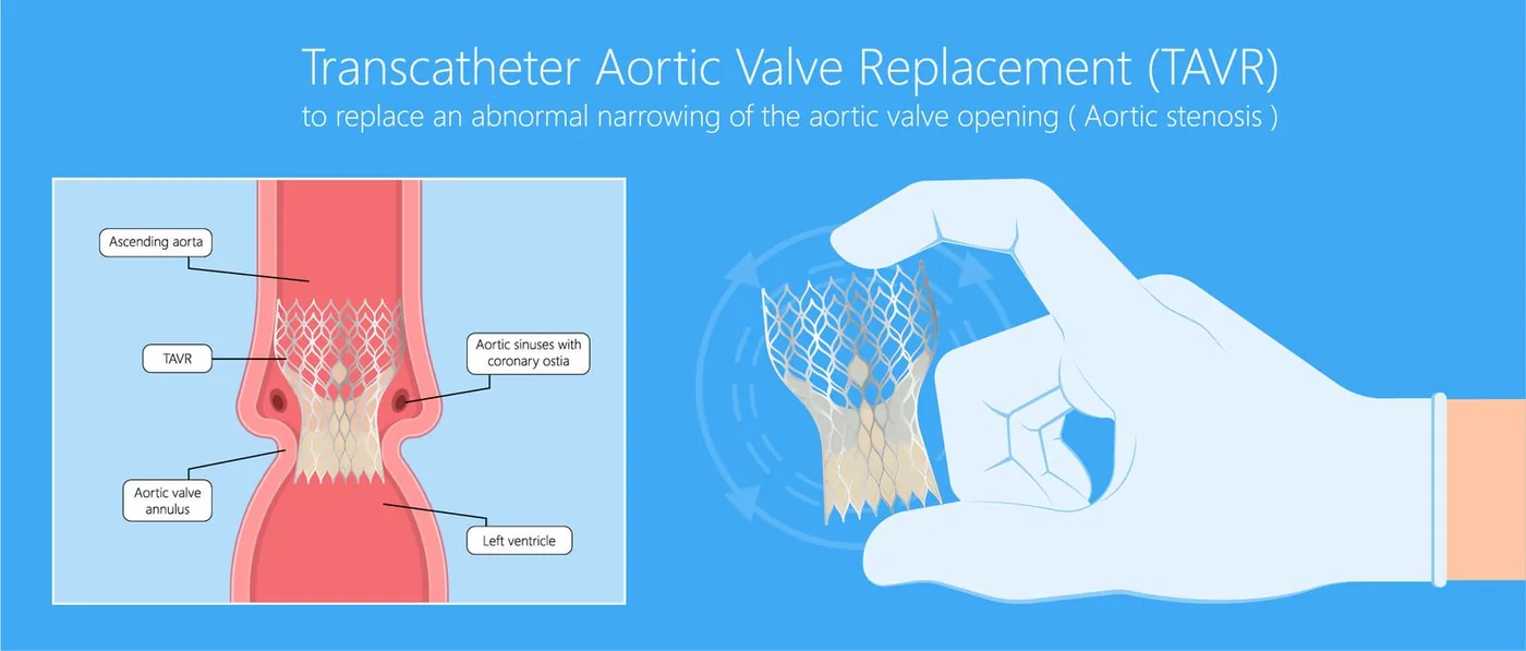 TAVI / TAVR